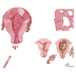 Menorrhagia