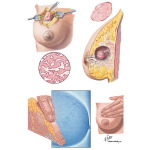 Breast: Fibroadenoma