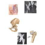 Disorders of the Thigh and Hip