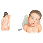 Pediatric Disorders