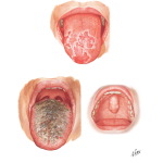 Common Oral Lesions