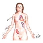 Pneumocystis Carinii Pneumonia