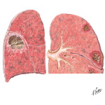 Lung Abscess
