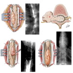 Intradural Spinal Tumors