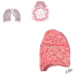 Cystic Fibrosis of the Pancreas