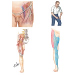 Lateral Femoral Cutaneous Nerve