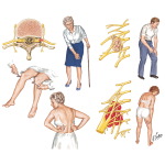 Radiculoplexopathies