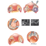 Management Options for Pelvic Mass