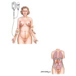 Postoperative Management of Ovarian Cancer