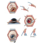Surgical Management