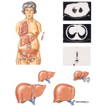 Metastasis in Colorectal Cancer