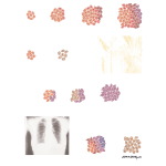 Tumor Biology and Chemotherapy