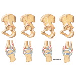 Lauge-Hansen Classification of Ankle Fractures