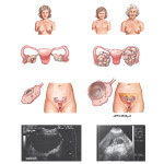 Clinical Evaluation of Ovarian Mass