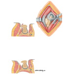Surgical Approaches to the Thigh and Hip