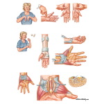 Carpal Tunnel Syndrome