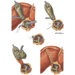 Gallstones