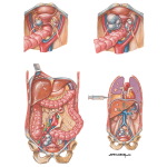 Staging of Ovarian Cancer