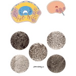 Prostate Cancer