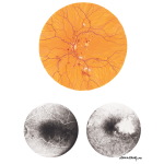 Diabetic Retinopathy