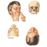 Examination for Zygomatic Fracture