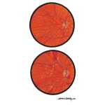 Optic Disc