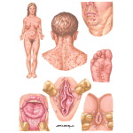 Syphilitic Lesions