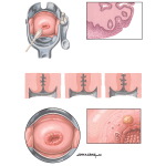 Colposcopy