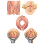 Double Anal Obsession Protein Powder Cause Anal Fissure