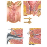 Appearance and Management of Anorectal Crohn Disease
