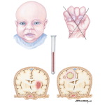 Clinical Characteristics of Too Little Pulmonary Flow