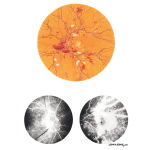 Diabetic Retinopathy