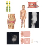Hemophilia A and B
