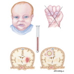 Clinical Characteristics of Too Little Pulmonary Flow