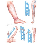 Varicose Veins