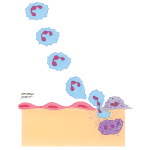 Vasculitis