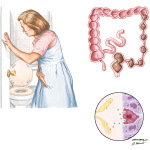 Irritable Bowel Syndrome (IBS)
