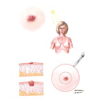Melanoma