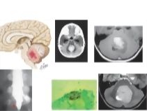 Brain Tumors In Children