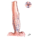 Varicosis