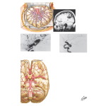 Vascular Malformations and Aneurysms