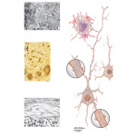 Microscopic Pathology In Alzheimer's Disease