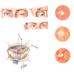 Ophthalmologic Manifestations of Cerebral Aneurysms