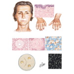 Progressive Systemic Sclerosis (Scleroderma) and Rheumatoid Arthritis