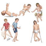 Cerebral Palsy