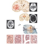 Gliomas