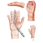 Tenosynovitis and Infection of Fascial Space