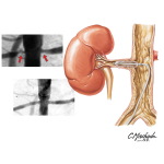 Balloon Angioplasty of Stenotic Renal Arteries
