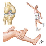 Rupture of Anterior Cruciate Ligament