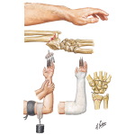 Flexion - Compression Fracture of Distal Radius (Smith Fracture)